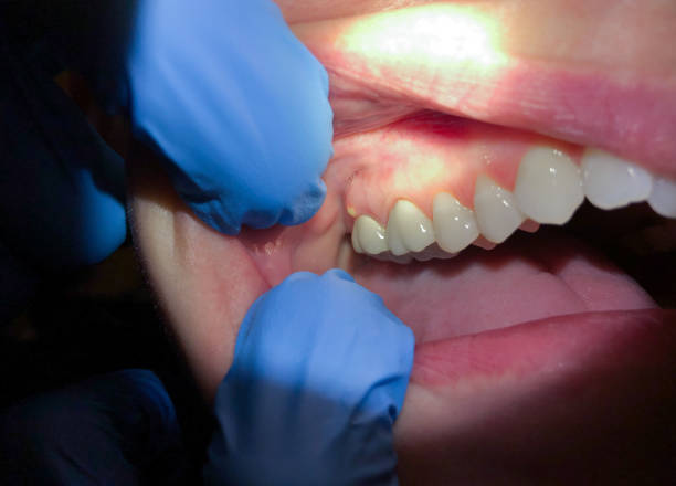Best Emergency Treatment for Oral Infections in Shelby, NC